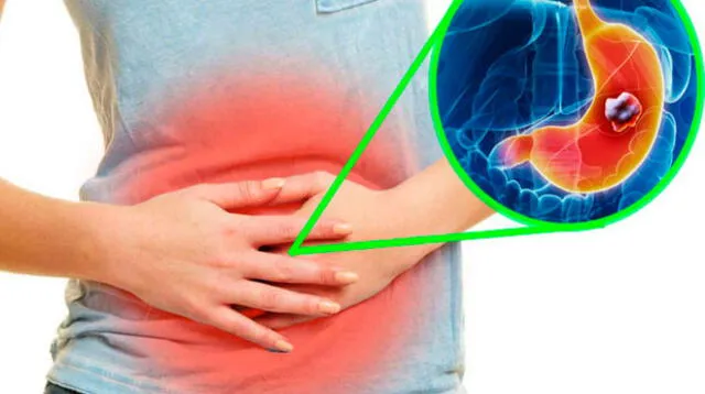 En la mayoría de casos el cáncer de estómago es causado por la infección de la bacteria Helicobacter pylori