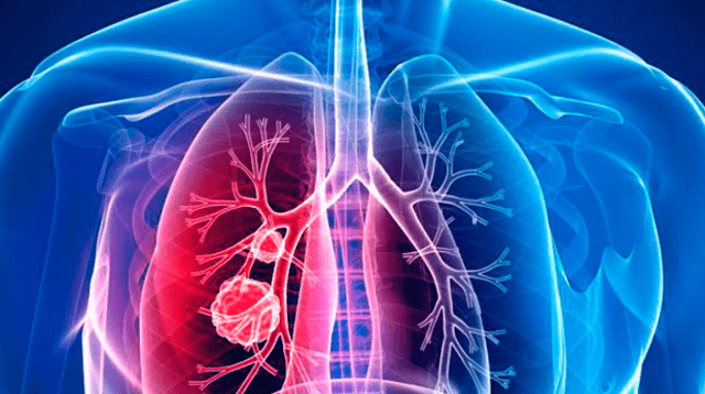 El cáncer de pulmón tiene la más alta de mortalidad a nivel mundial