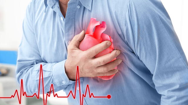 La acumulación de colesterol y grasa en las paredes de la artería pueden producir bloqueo