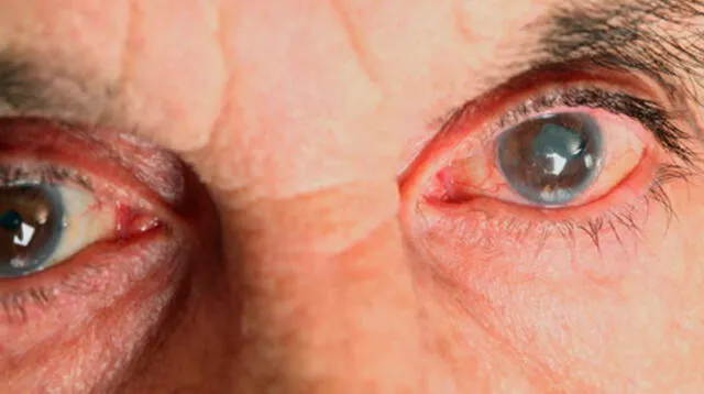 El Glaucoma es una enfermedad silenciosa y crónica 