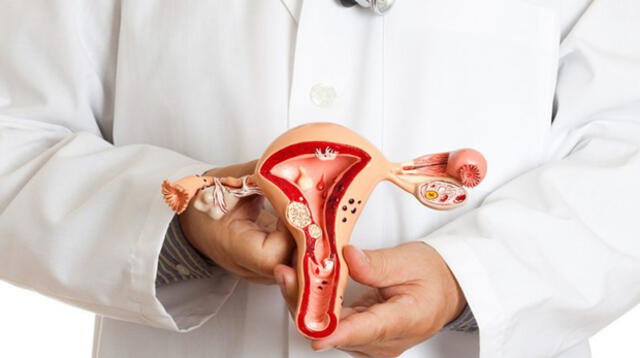  El 92% de los cánceres uterinos ocurren en el endometrio