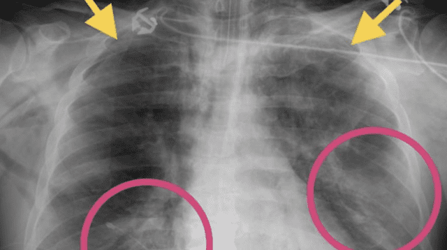 Las imágenes mostraron zonas de opacidad en los pulmones provocados por el covid-19.