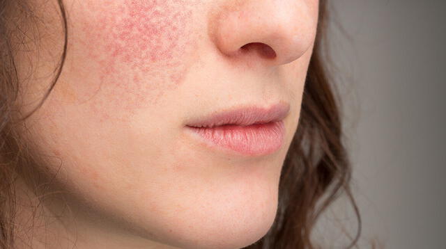 La piel de la cara y del cuerpo se pone muy seca e irritable.