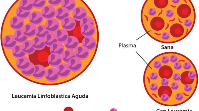 Las leucemias se dividen en dos tipos principales: Aguda (que progresa rápidamente).