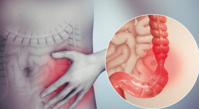 Salud: ¡Ten cuidado con la diverticulosis!