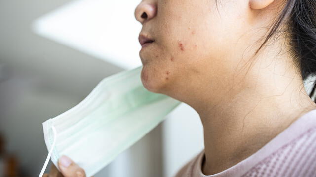 La mascarilla puede causar problemas en la piel como la dermatitis atópica.