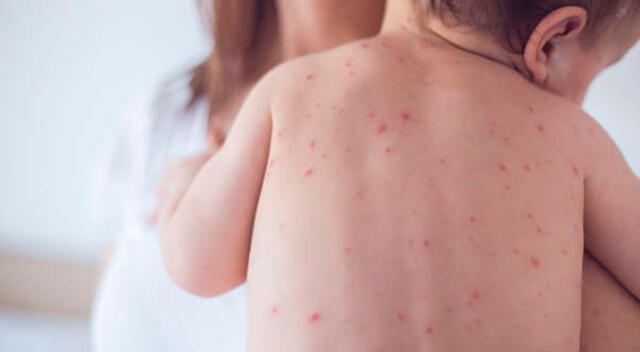 La varicela se previene a través de una vacuna que se aplica a partir de los 12 o 15 meses de edad.