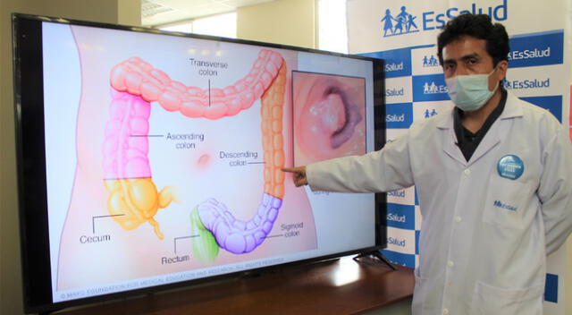 Incremento de cáncer de colon en pandemia.