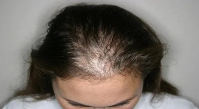 La alopecia no es tan común en mujeres, pero si crees que la sufres, visita a un especialista.