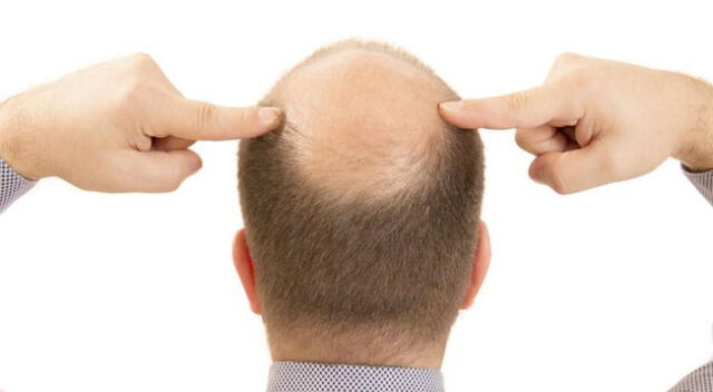 La alopecia es la caída anormal del cabello, generalmente es genética.