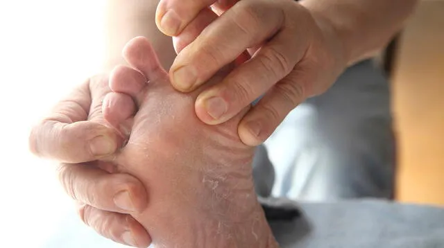 El pie de atleta es un problema que tienen muchas personas en la zona del pie debido a un hongo.