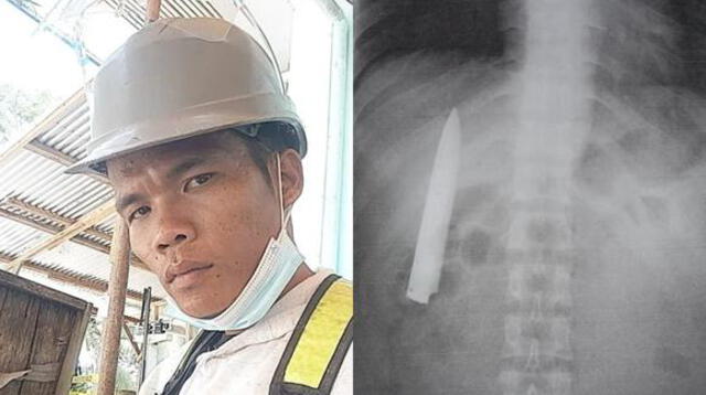 El hombre se enteró que tenía un objeto punzocortante cuando acudió a realizarse una prueba de rayos X.