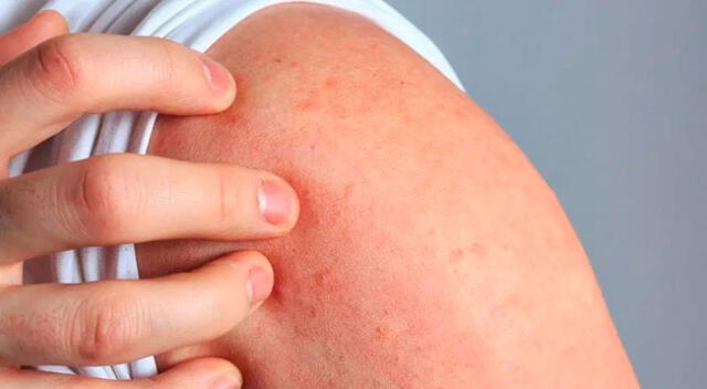 El síntoma principal de la dermatitis atópica es el sarpullido.