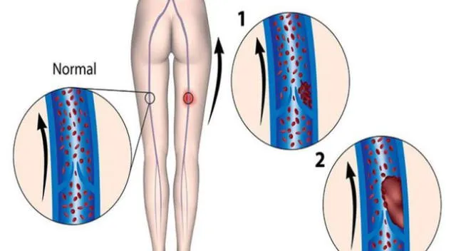 La trombosis venosa profunda es cuando un coágulo obstruye tus venas.