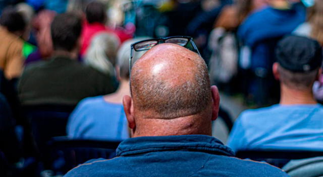 El estudio indicó que los hombres con alopecia pueden desarrollar COVID-19 grave.