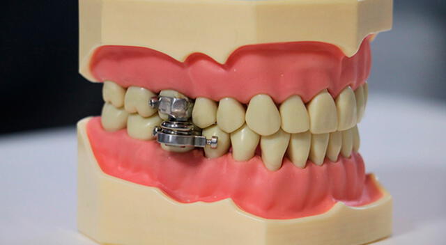 Los imanes en el dispositivo solo permiten que la mandíbula se separe dos milímetros, lo suficientemente grande para una pajita.