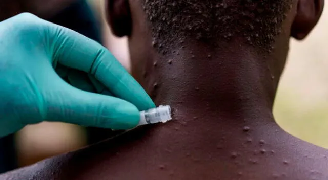 Se trata de una enfermedad viral rara que ocurre en África central y occidental.