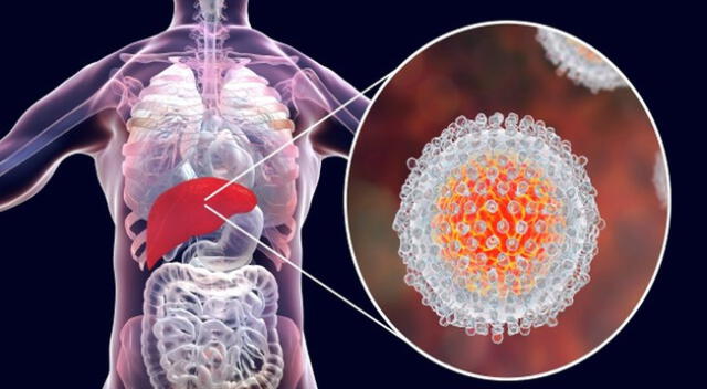 La hepatitis vírica.