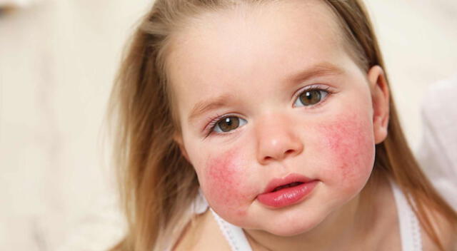 Se conmemora el Día Mundial de la Dermatitis Atópica.