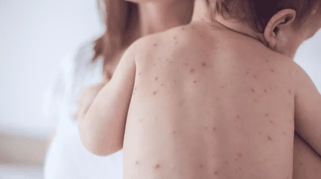 La varicela puede causar complicaciones graves como neumonía e infecciones en la piel.