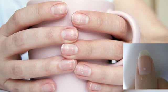 Las manchas blancas en la uñas no son por falta de calcio.