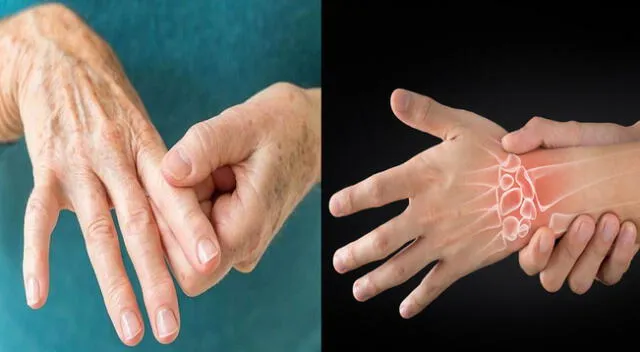 La artritis debe detectarse a tiempo para evitar mmayores consecuencias.