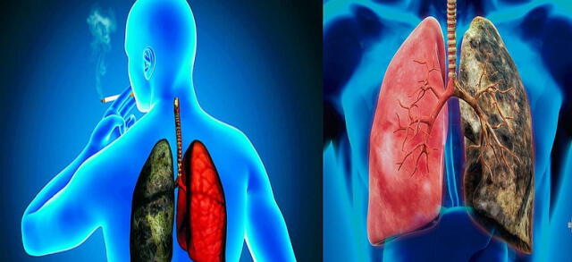 El cáncer de pulmón es uno de los más letales.