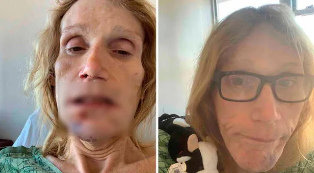 Kristina Frost ha tenido que someterse a dos cirugías para colocar su mandíbul.a