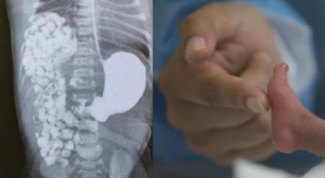 VES: médicos salvan a recién nacido que tenía intestino alojado en el tórax