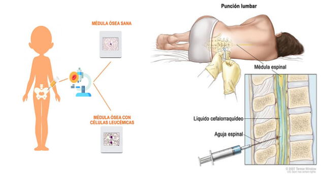 Deben estar muy atentos a los síntomas de la leucemia linfoblástica aguda infantil