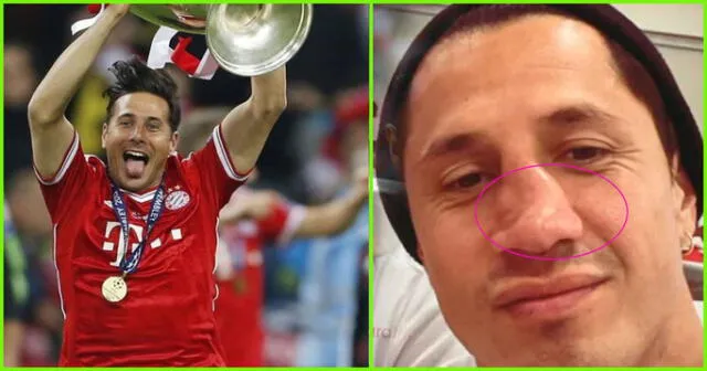 En la celebración de la selección peruana, Gianluca mostró como quedó su nariz: totalmente aplastada.