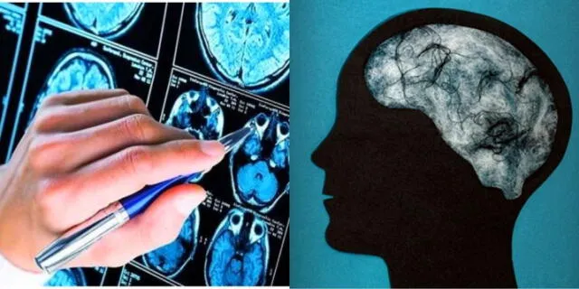 Nuevos estudios revelan daños al cerebro vinculados al COVID-19.