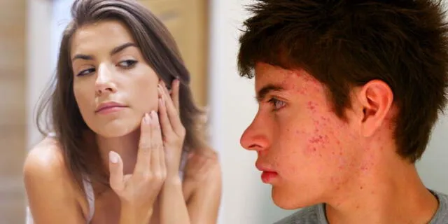 El acné no solo aparece en la adolescencia, también esta presente en los adultos.