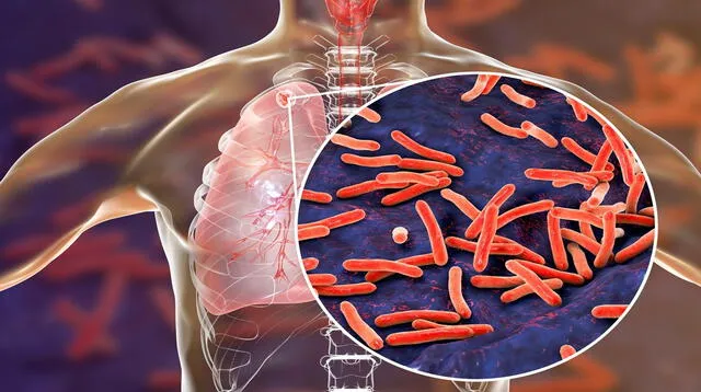 Conoce todo sobre la Tuberculosis.