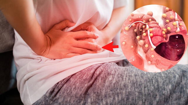 Conoce todo sobre el cáncer al colon