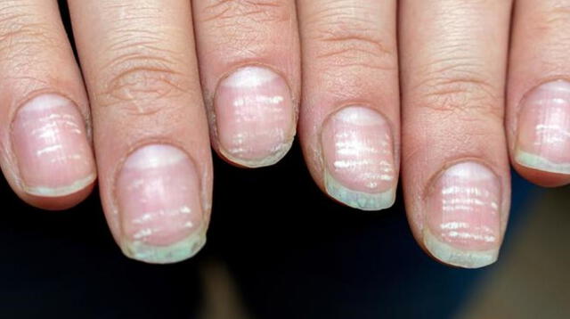 Uno de los síntomas que manifiesta el COVID-19 de desarrolla en las uñas.