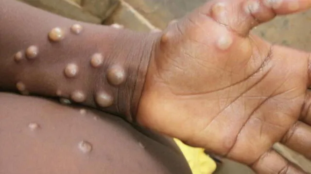 La viruela del mono es una enfermedad originaria de África que viene expandiéndose en el mundo.
