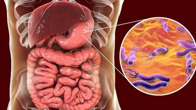 H. pylori: Es un microorganismo al que se le atribuye el desarrollo de cáncer de estómago.