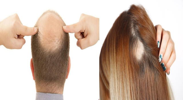 La calvicie y la alopecia tienen diferentes causas.