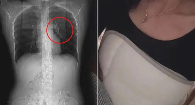 Una mujer en China terminó en un hospital tras sufrir un ataque de tos por comer comida picante.