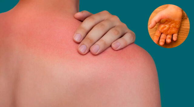 ¿Existen quemaduras en la piel ante una ola de calor?