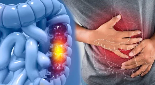 Conoce qué señales podrían indicar que tendrías cáncer de colon.