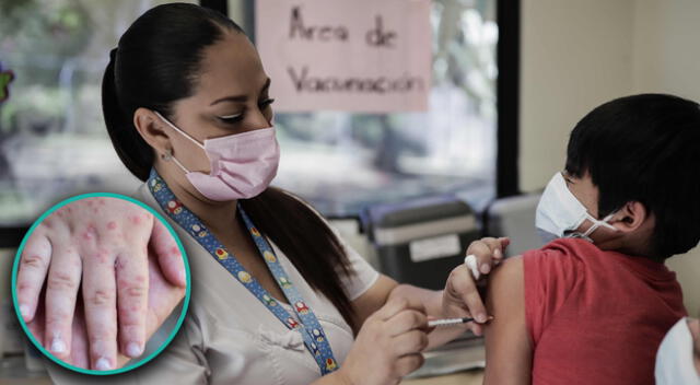 Lima y Callao están en estado de emergencia por sarampión y polio.