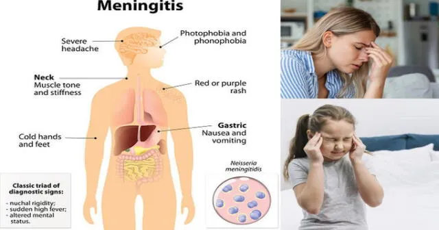 Hay que protegerse de la meningitis.