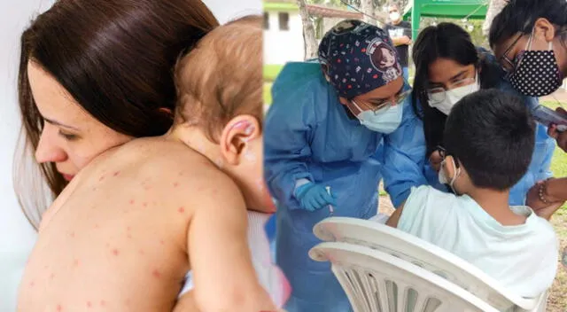 Bebé de 10 meses presenta Sarampión y se hizo un cerco epidemiológico en Surco.