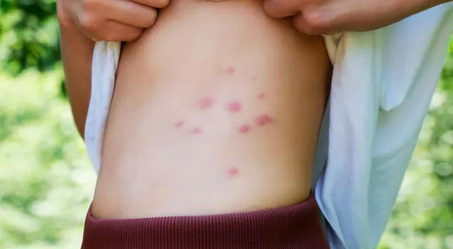 Picadura en el cuerpo de un niño debido a las pulgas.