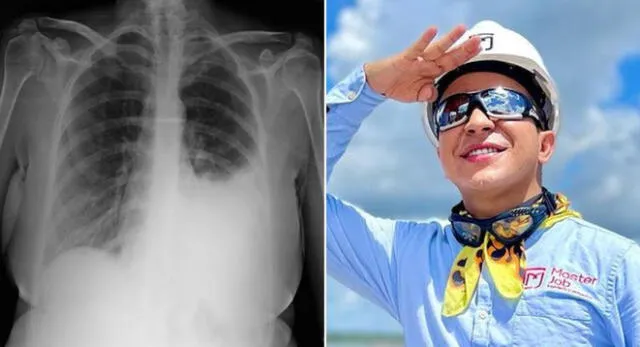 ‘Ingeniero bailarín’ tuvo derrame pleural.