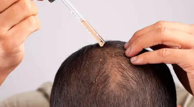 El medicamento contra la caída del cabello que tiene efectos secundarios. El medicamento contra la caída del cabello que tiene efectos secundarios.