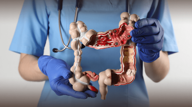 Examen en heces y colonoscopia disminuyen mortalidad casi en su totalidad. Examen en heces y colonoscopia disminuyen mortalidad casi en su totalidad.
