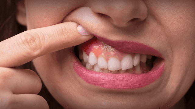 Periodontitis: la enfermedad dental que podría aumentar el riesgo de cáncer de colon.